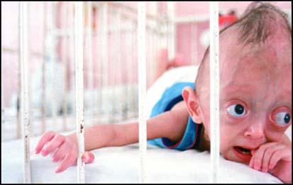 A baby in Tu Du Hospital suffering from the consequences ofAgent Orange being dropped on Vietnam 30 years ago.